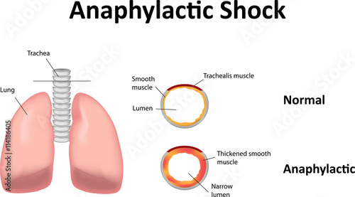 Anaphylactic Shock photo