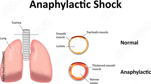 Plakat Anaphylactic Shock