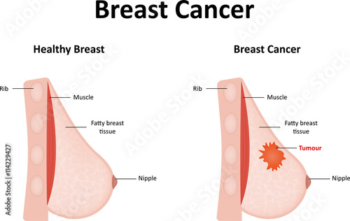Breast Cancer