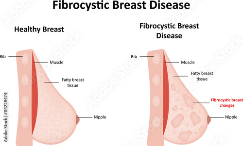 Fibrocystic Breast Disease