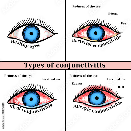 Conjunctivitis types. Inflammatory diseases of eyes.