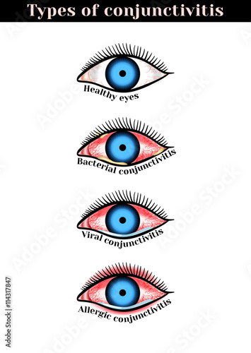 Conjunctivitis types. Inflammatory diseases of eyes.
