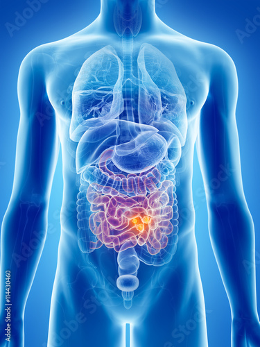 3d rendered, medically accurate illustration of small intestine cancer