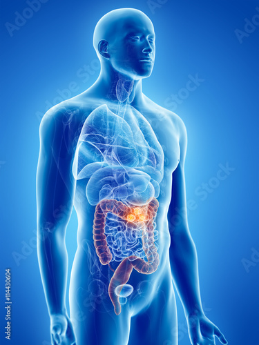 Canvas-taulu 3d rendered, medically accurate illustration of bowel cancer