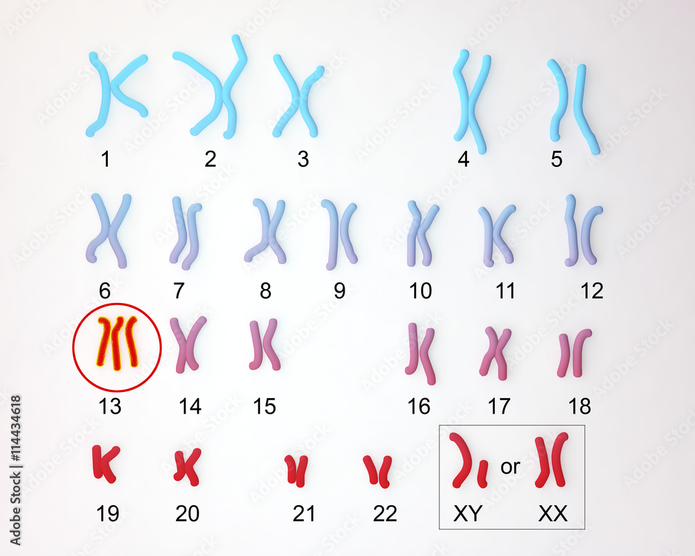 Patau-syndrome karyotype, male or female, labeled. Trisomy 13. 3D ...