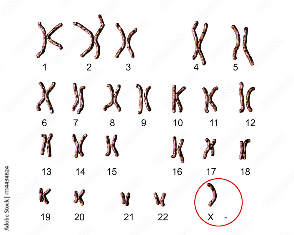 Turners Syndrome Karyotype Labeled X0 Karyotype 3d Illustration