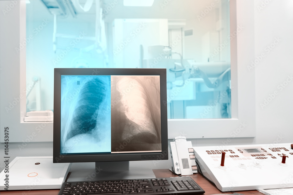 X-ray picture of lungs on a computer monitor X-ray picture of lungs on a computer monitor