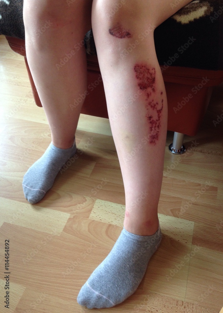 Fotografia do Stock: Verletzte Bein mit Schürfwunde