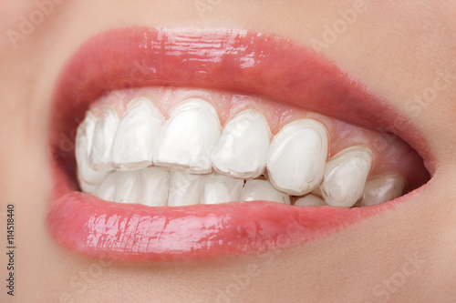 teeth with whitening tray smile dental