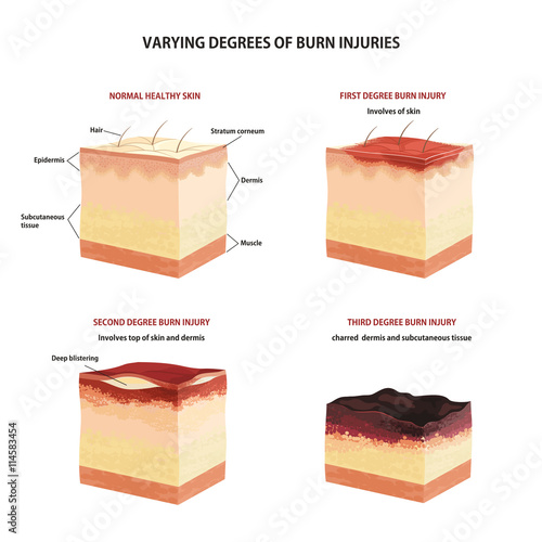 Skin burn classification.