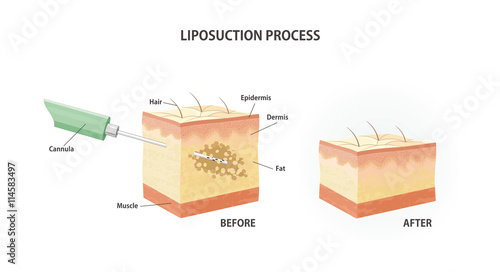 Liposuction process.