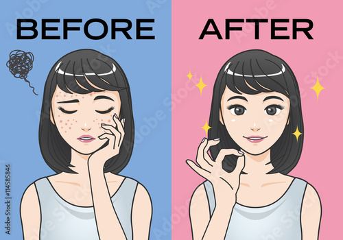 acne treatment before after cartoon illustration