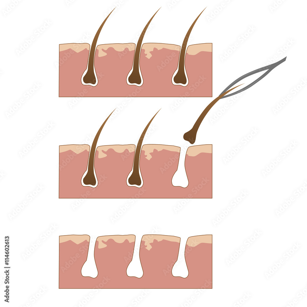 Example of hair removal from skin with tweezers Example of hair removal from skin with tweezers