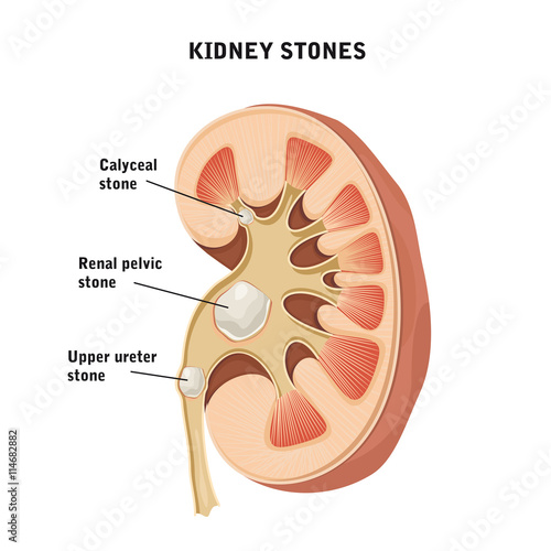 Kidney stones.