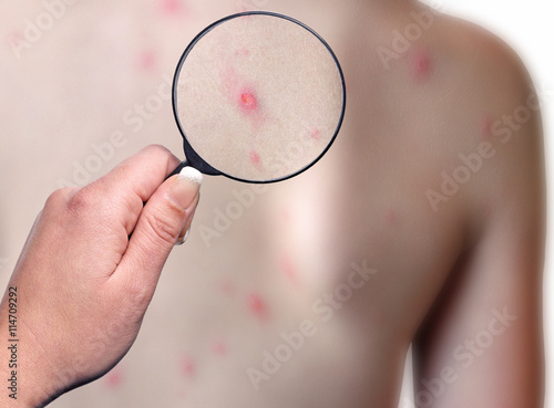 Patient with chickenpox disease, medical examination photo