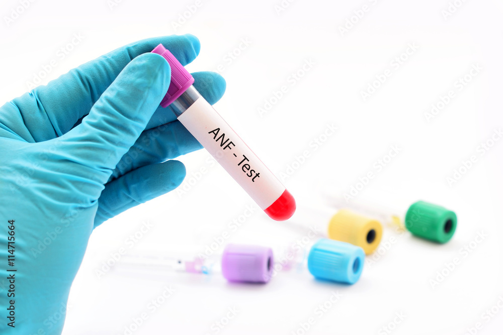 Blood for anti-nuclear factor (ANF) test, diagnosis for autoimmune disease Blood for anti-nuclear factor (ANF) test, diagnosis for autoimmune disease