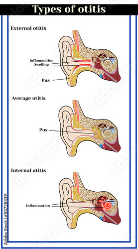 Types of otitis : external, average and internal otitis. Inflammatory diseases of the ear.      