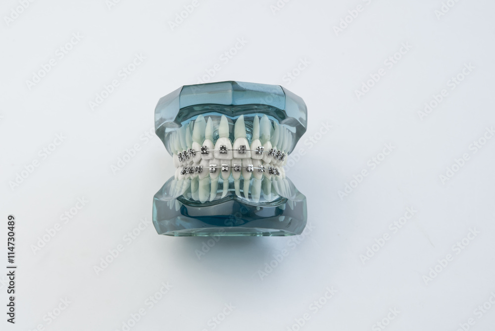 Model of human jaw with wire braces attacheg on white backgroun Model of human jaw with wire braces attacheg on white backgroun