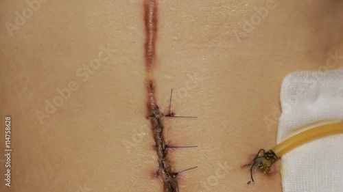 scar from operation with a black fiber. Stitched up skin after an operation to remove a cancerous mole photo