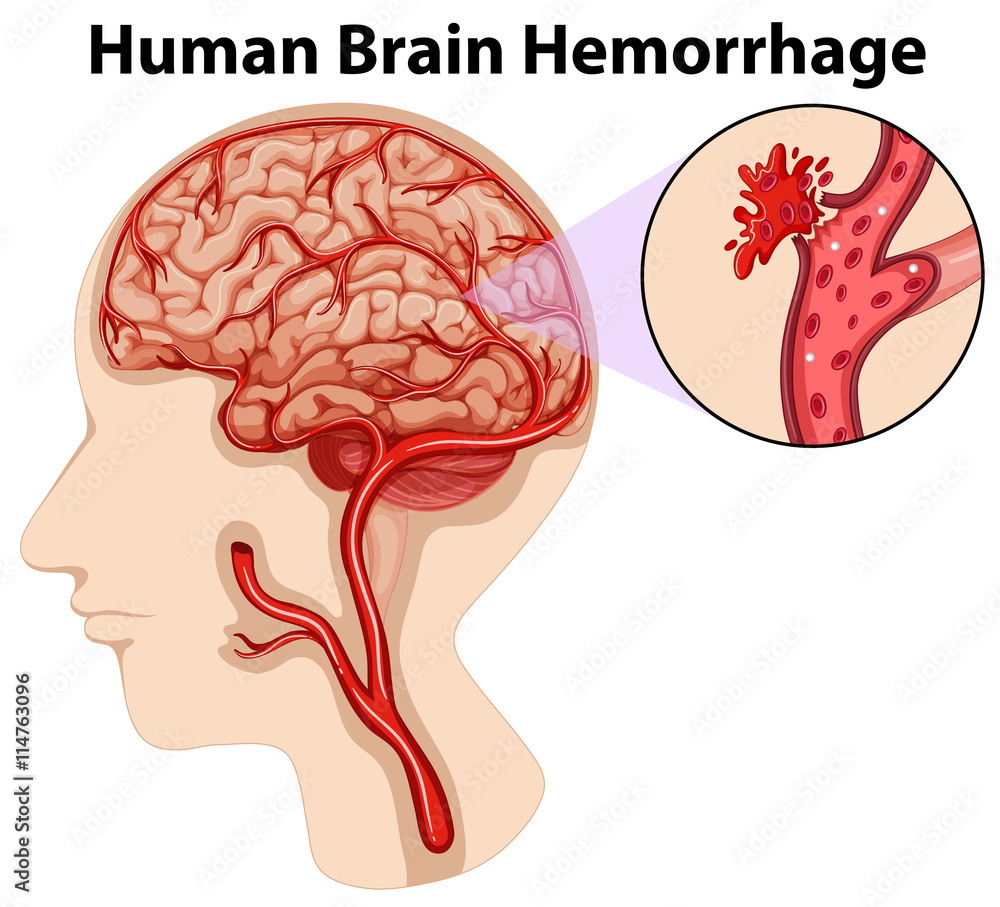Diagram of human brain hemorrhage Stock Vector Adobe Stock