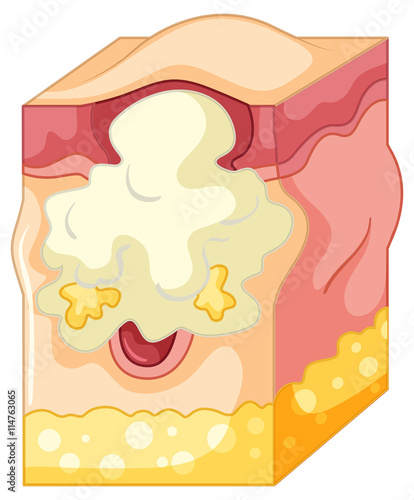 Fat under human skin caused pimple