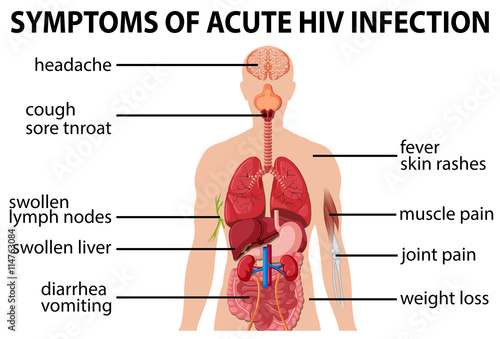 Chart of symtoms of acute HIV infection