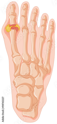 Diagram showing gout toe