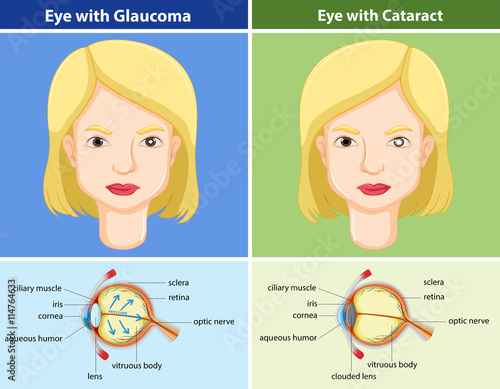 Comparison chart of eyes with and without glaucoma