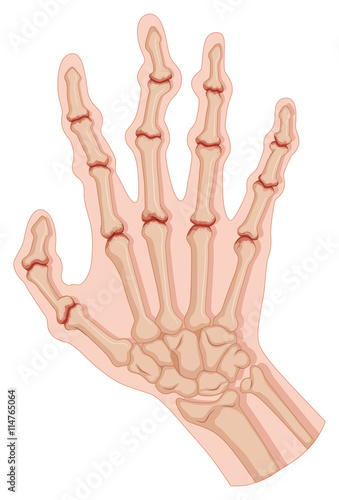 Rheumatoid arthritis in human hand