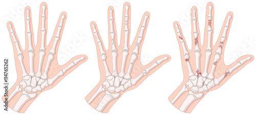 Diagram showing hand fracture © GraphicsRF