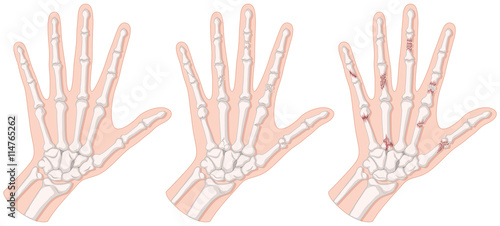 Diagram showing hand fracture