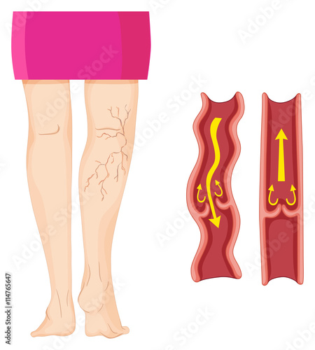 Varicose veins in human leg.