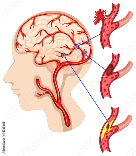 Caner in human brain
