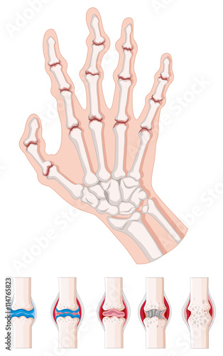 Rheumatoid arthritis diagram on white