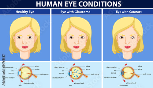 Diagram showing human eye conditions
