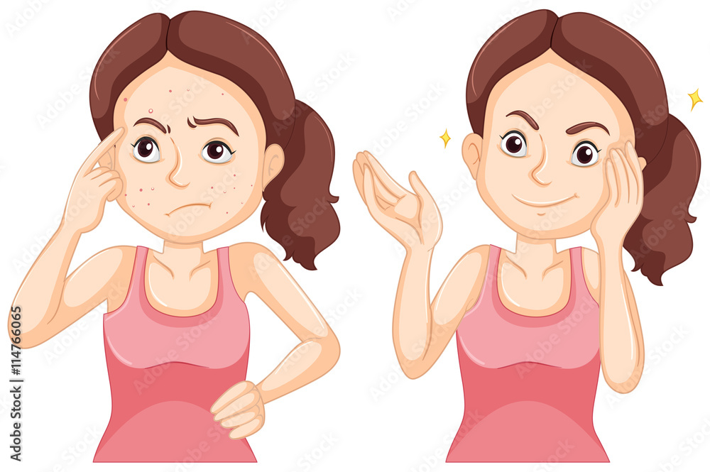 Girl before and after having pimple on her face. Girl before and after having pimple on her face.