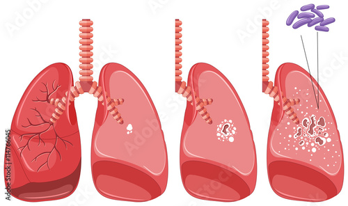 Tuberculosis in human lungs