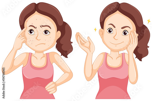 Girl before and after having pimple on her face.