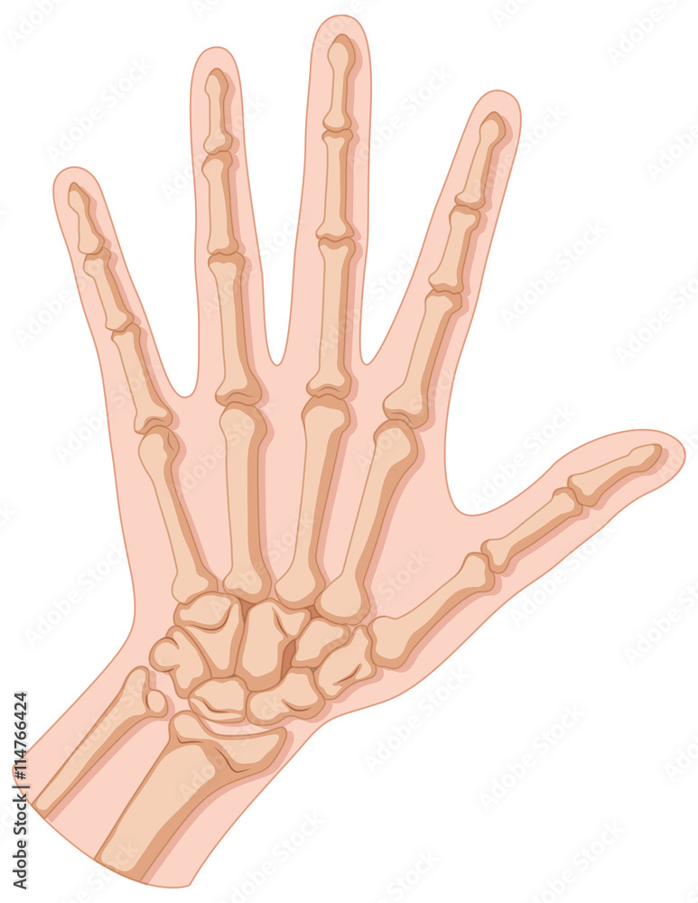 Fracture in human hand Fracture in human hand