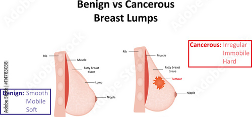 Benign Vs Cancerous Breast Lumps