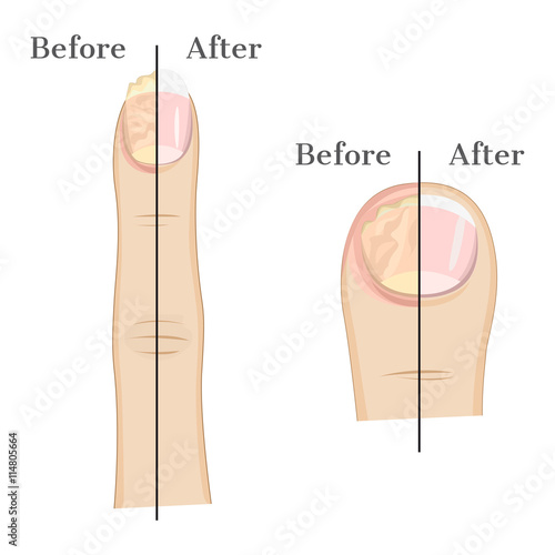 Fungal infection of the nails Illustration Before and After