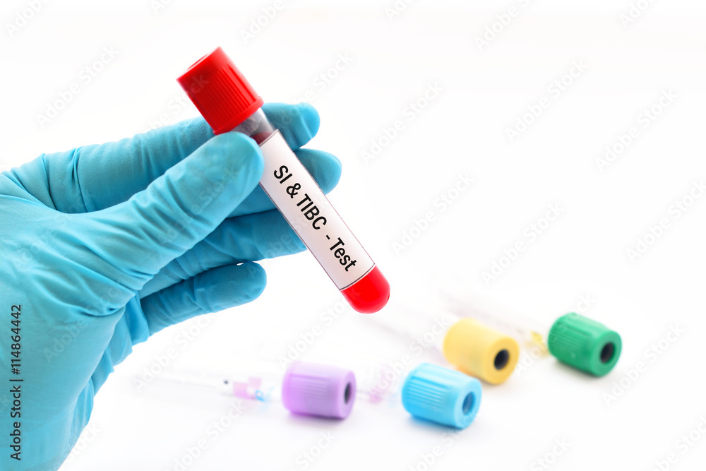 Blood sample for serum iron (SI) and total iron binding capacity (TIBC