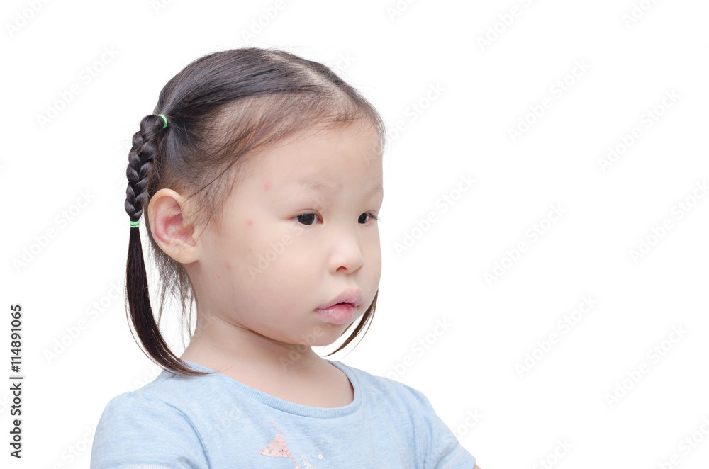 Little asian girl with red sport from mosquitoes bite on face Little asian girl with red sport from mosquitoes bite on face