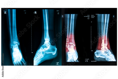 human foot right ankel xray picture with plate and screws