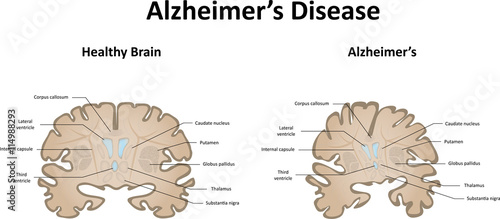 Alzheimer's Disease