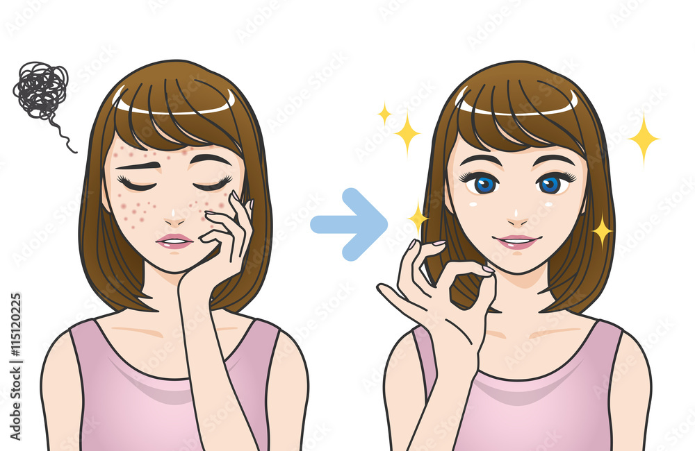 acne treatment before after cartoon illustration acne treatment before after cartoon illustration