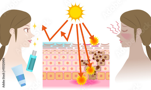 UV care before after image, young girl puts on the sunscreen or not, mechanism of the sunburn, vector illustration