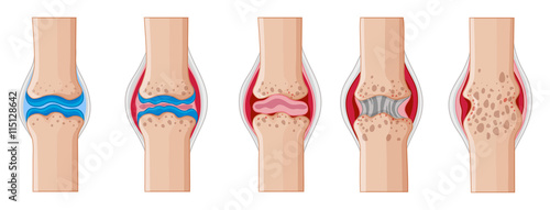 Rheumatoid arthritis in human joints