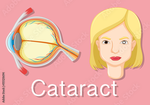 Diagram showing unhealthy eye with cataract