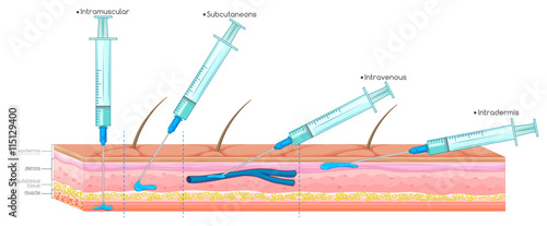 Diagram showing injection with syringe